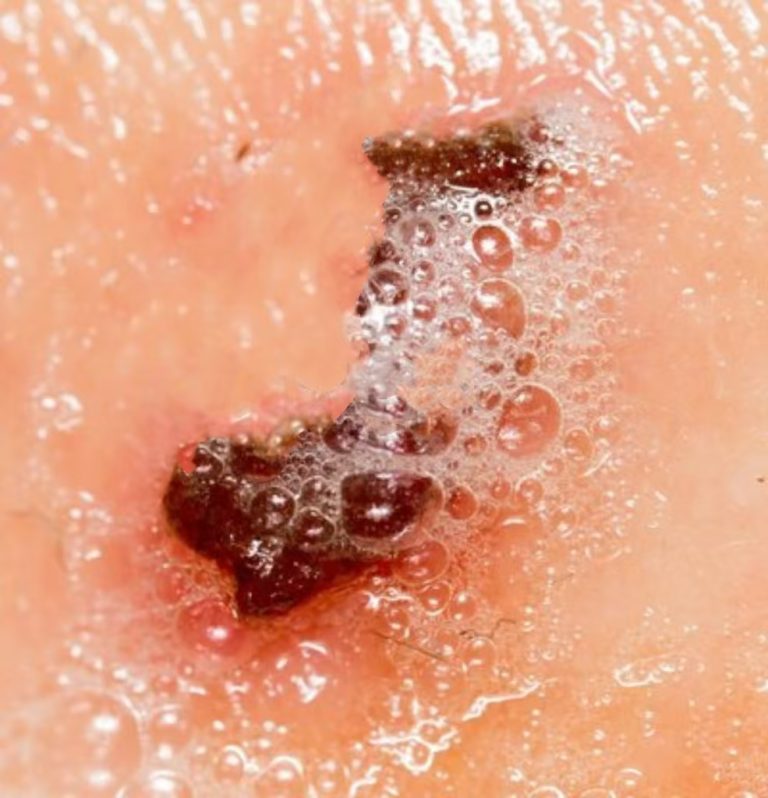 hydrogen peroxide on wounds